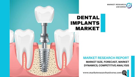 Dental Implants Market Research Report
